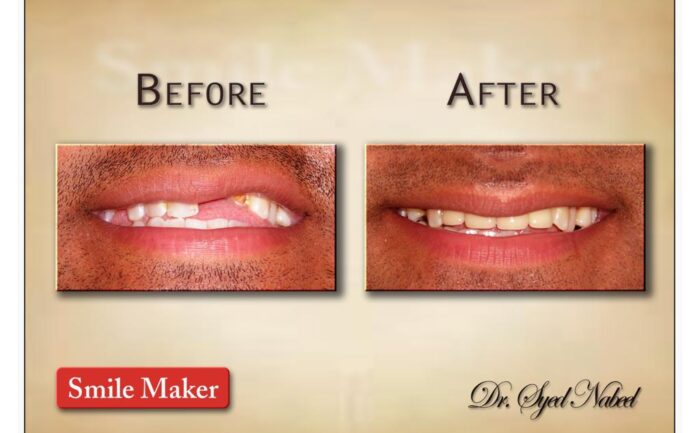 Alt="tooth replacement"