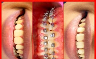 🦷 FAQ: Caring for Your Teeth After Dental Implants