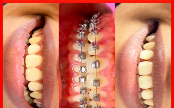 Alt="Braces"