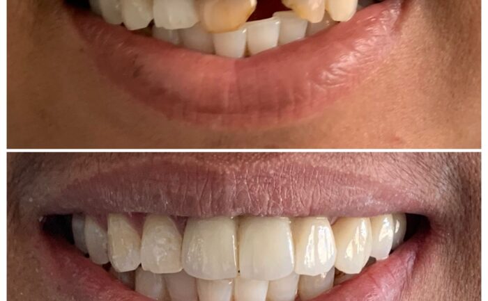 Alt= "smile Makeover"