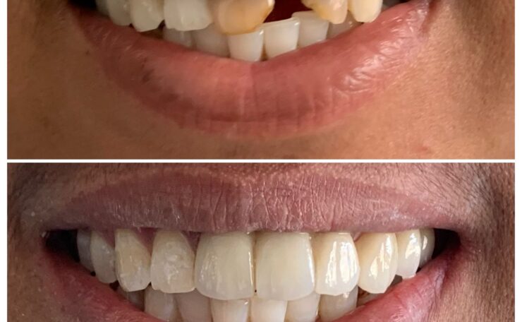 Alt= "smile Makeover"