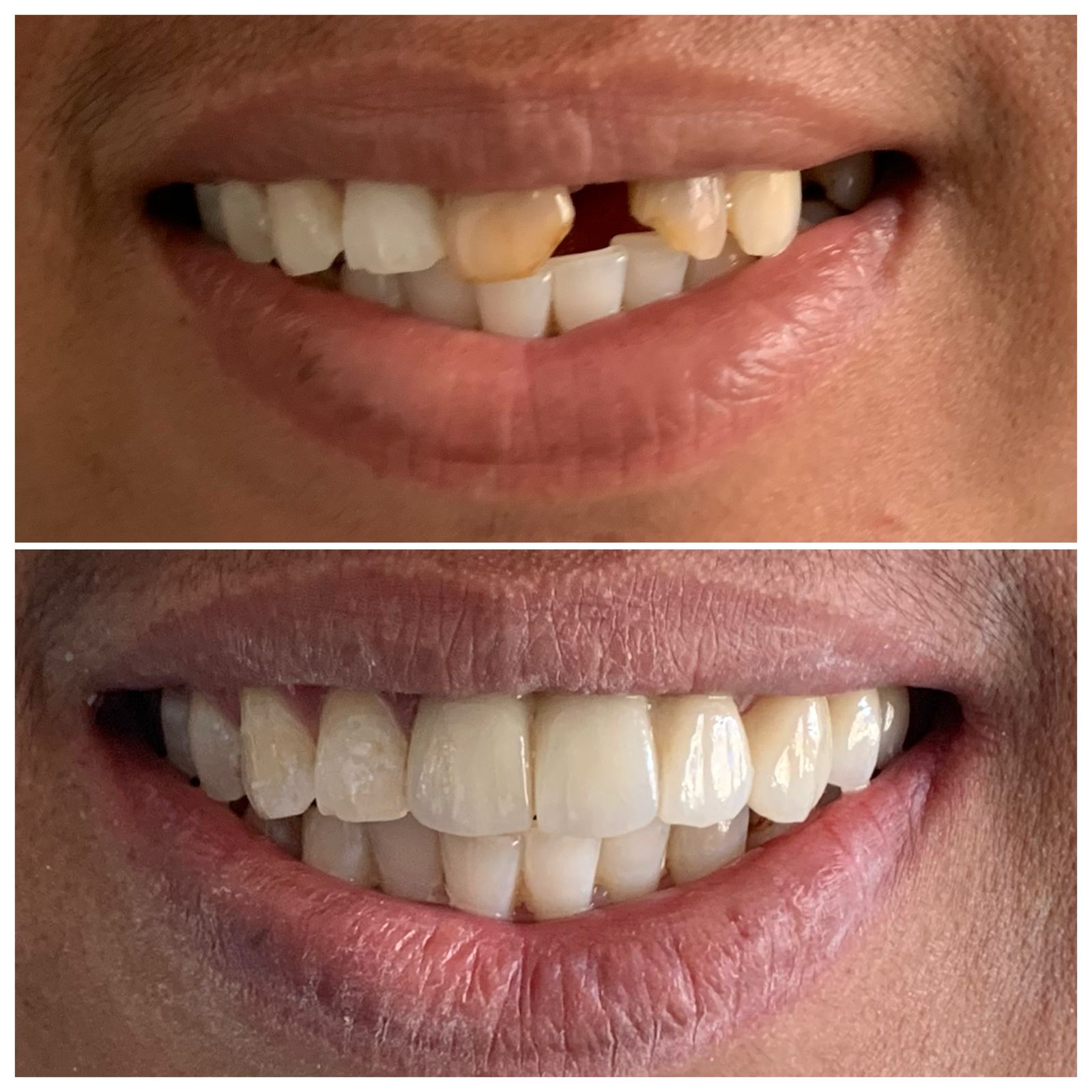 Alt= "smile Makeover"
