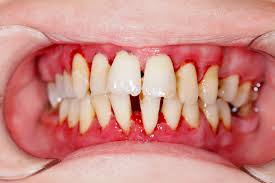 ALT="BLEEDING GUMS"
