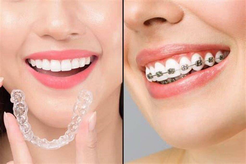 Alt="braces"