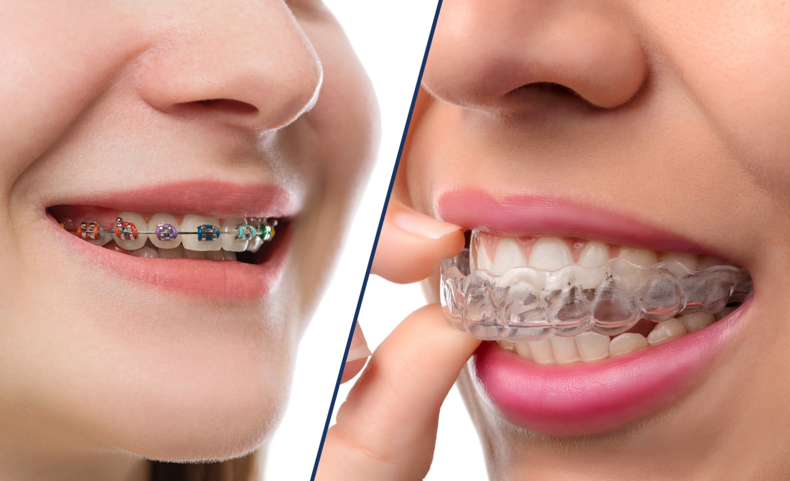 Alt="Invisalign"