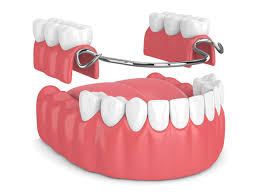 Alt=Denture"