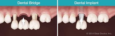 Alt="mysore implant clinic"