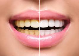 Alt="Stained Teeth"